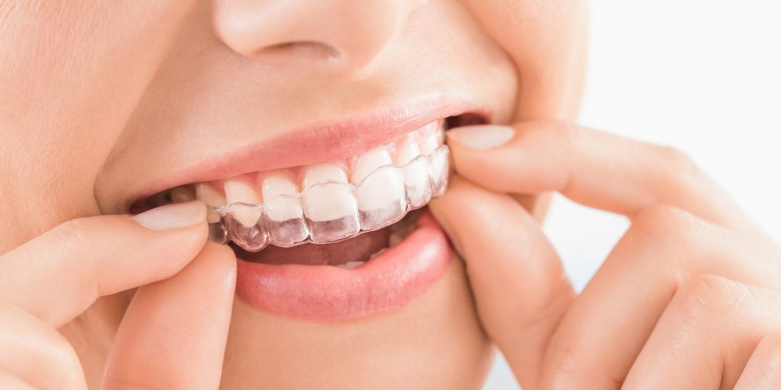 Aligning All The Options Best Teeth Aligners In The UK