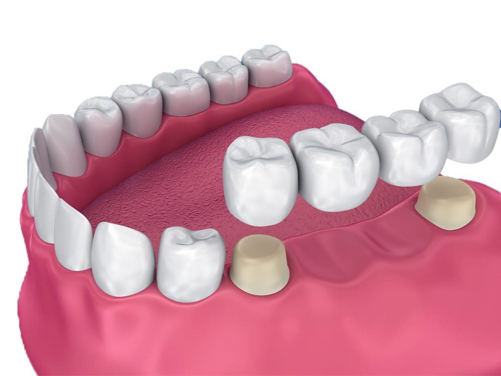 Dental Crowns: Everything You Need To Know