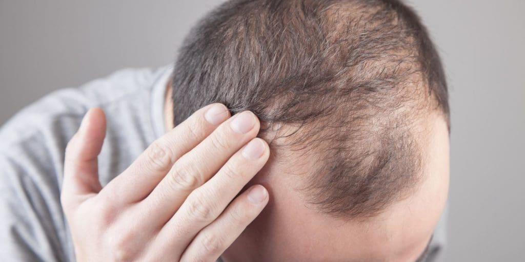 My Hair Is Thinning! How To Treat Male Hair Loss