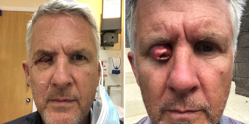 Bridgend man praises local opticians after detecting sight-threatening tumour