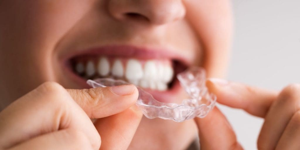 Know More About Clear Invisalign Aligners