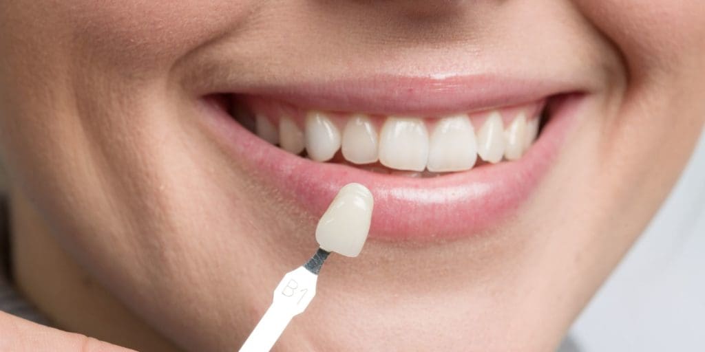 Reinventing Smiles with Dental Veneers