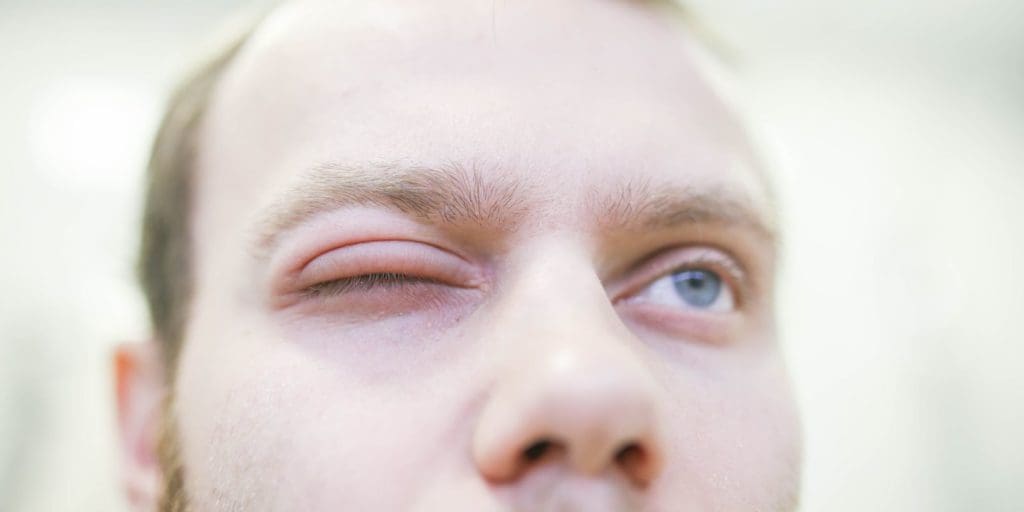 Taming Swellings: Dealing with Angioedema