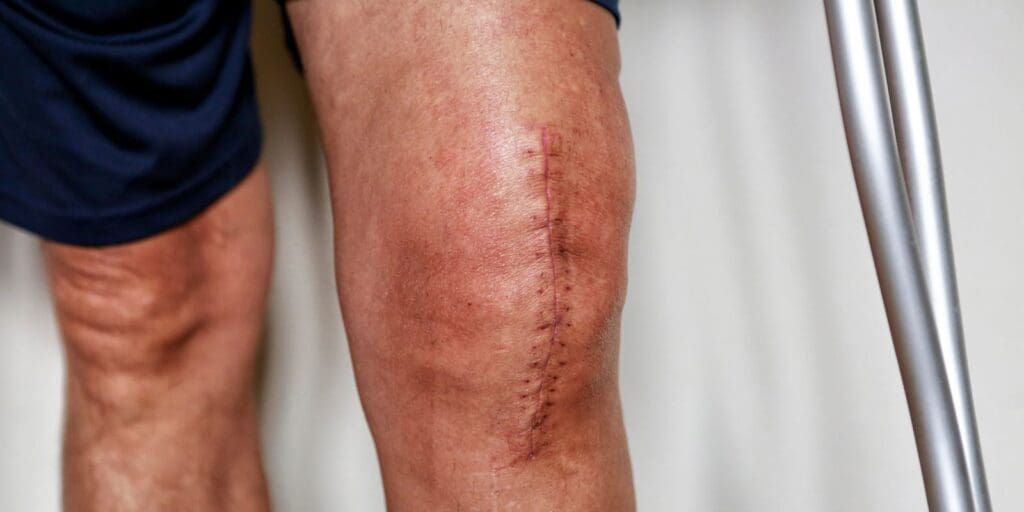 Avoiding Common Pitfalls During Your Knee Replacement Recovery Period