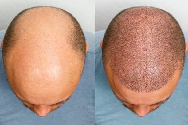 Decoding the Hair Transplant Abroad Phenomenon: A Global Perspective