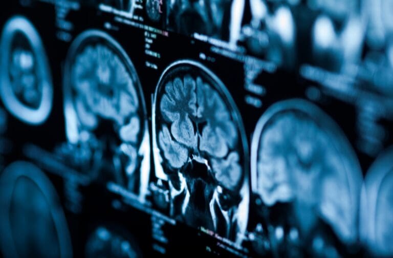 Brain cancer death rates in Wales show no improvement in more than 20 years